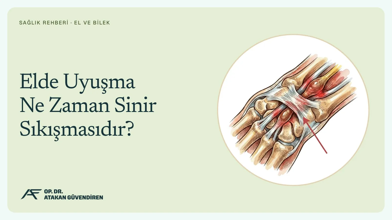 Elde Uyuşma Ne Zaman Sinir Sıkışmasıdır?