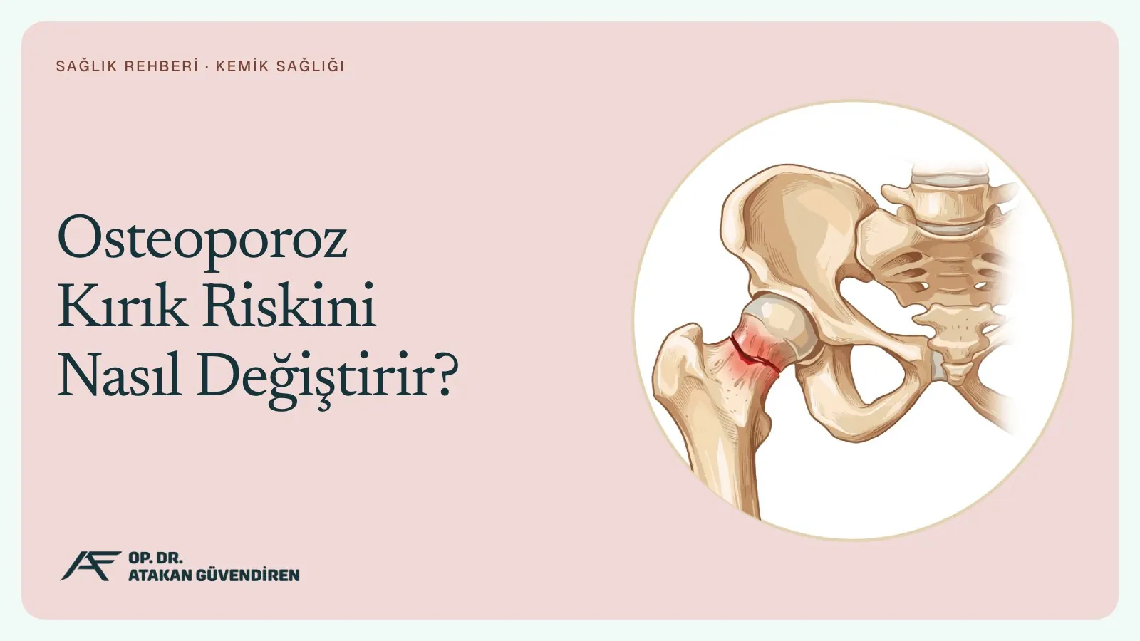 Osteoporoz Kırık Riskini Nasıl Değiştirir?